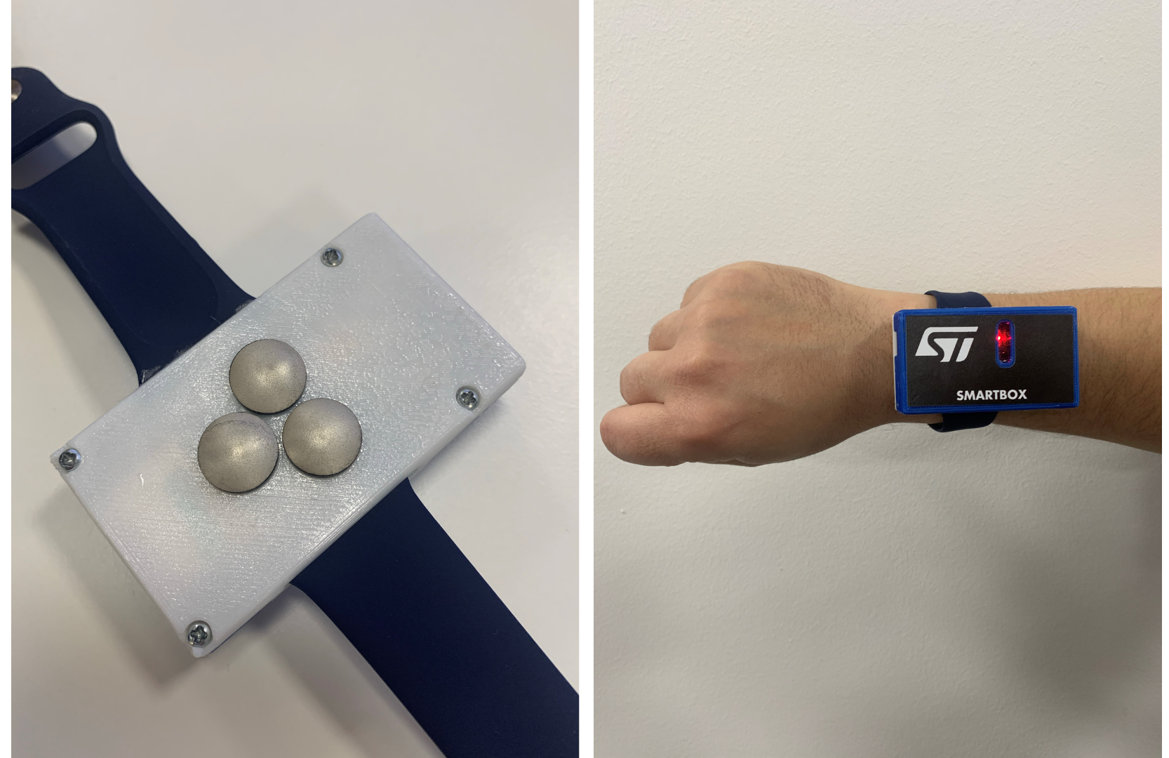 SoftPulse® Dome have been integrated with ST components to detect surface Electromyography signals from a wristband device